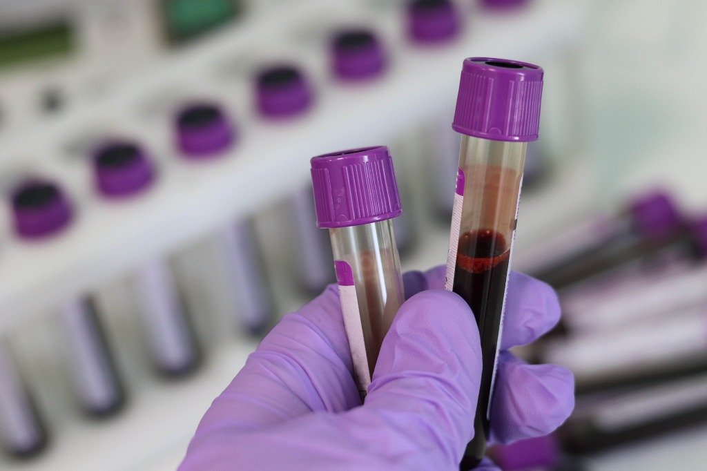 Lab technician holding blood sample collection tubes